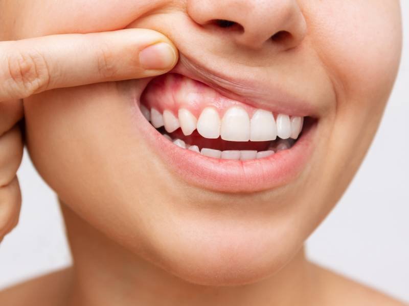 Advantages of Gingival Care