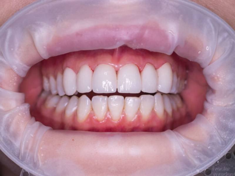 Ceramic Crowns