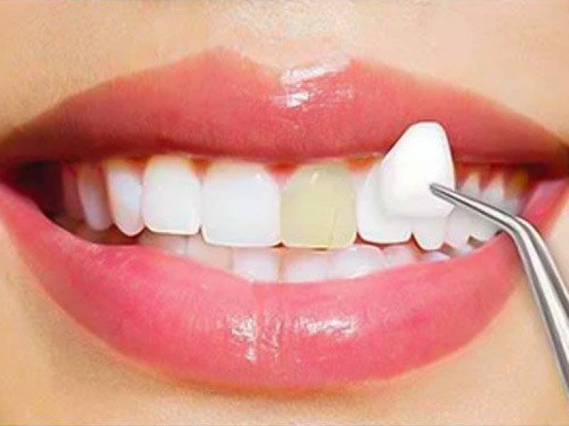 Composite Veneers Pros & Cons, Procedure and Cost