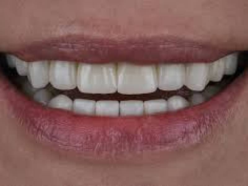 Composite Veneers