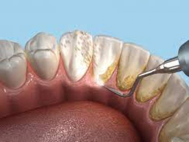 Dental Scaling and Polishing: Everything You Need to Know