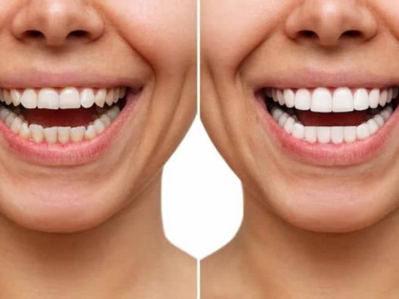 Enhancing Your Smile with Composite Veneers: A Cost-Effective Solution
