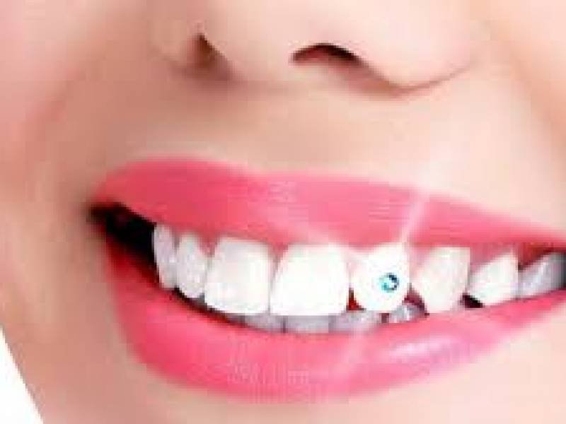 How To Remove Dental Diamond?