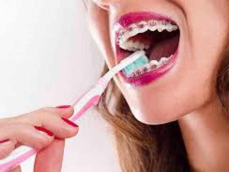 Metal Dental Braces