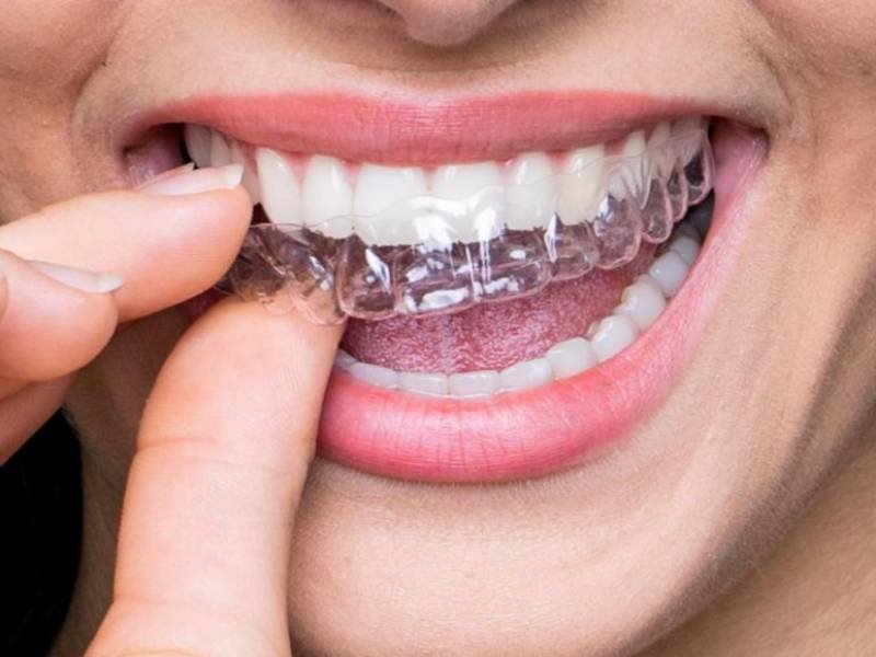 Porcelain Dental Braces (Transparent Dental Braces)