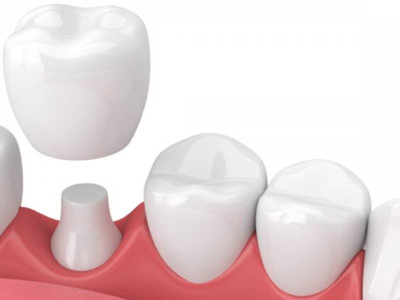 Porcelain Fused To Metal Pfm Crowns