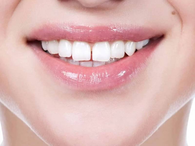 Teeth Gap Filling Cost: Factors to Consider for a Beautiful Smile