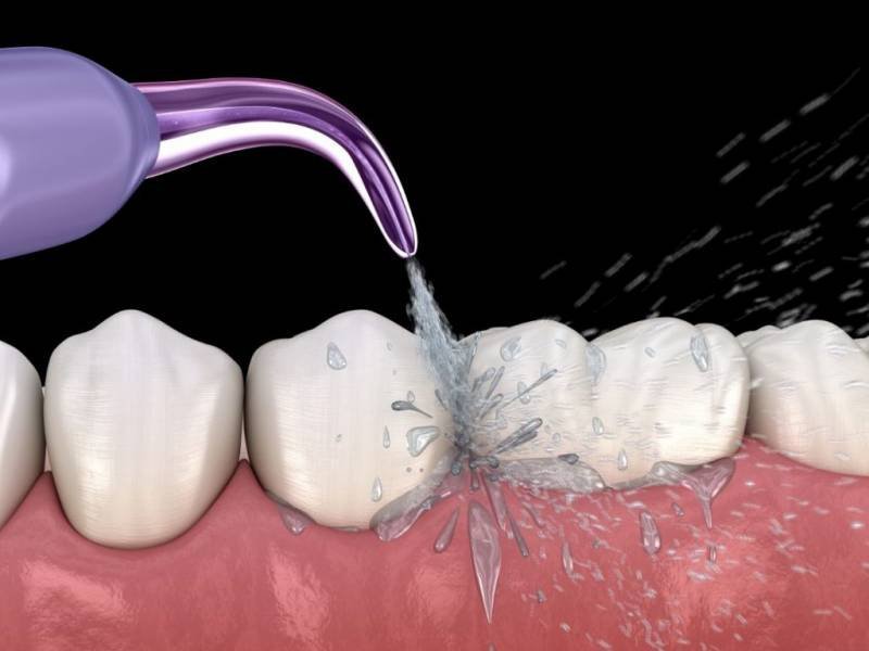 The Benefits of Air Flow Teeth Cleaning: An Effective Dental Hygiene Technique