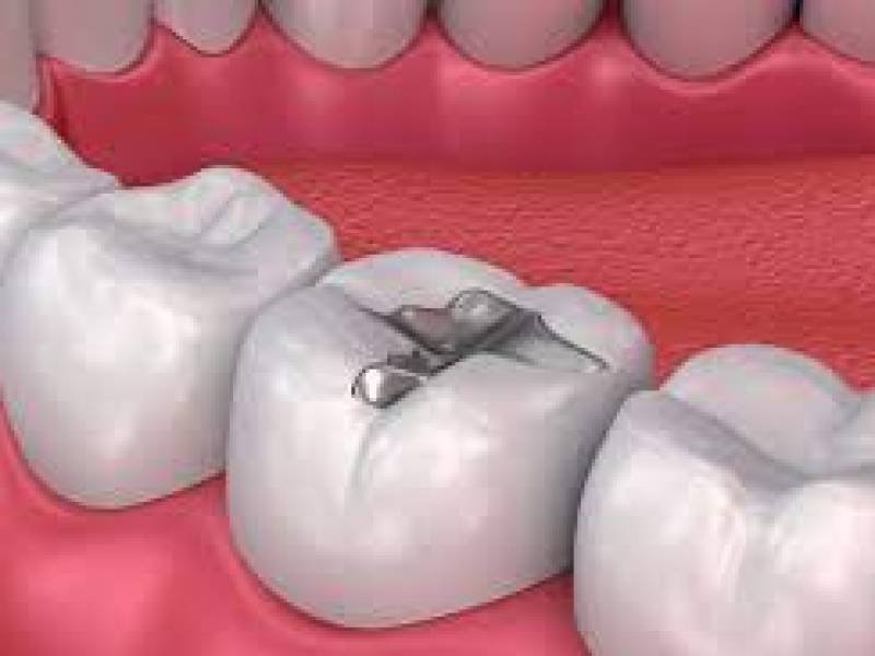 Which Type Of Dental Filling To Use Longer?