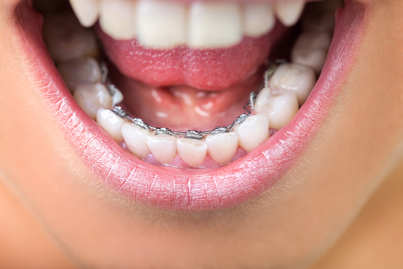 invisible Orthodontic Treatment (Braces)