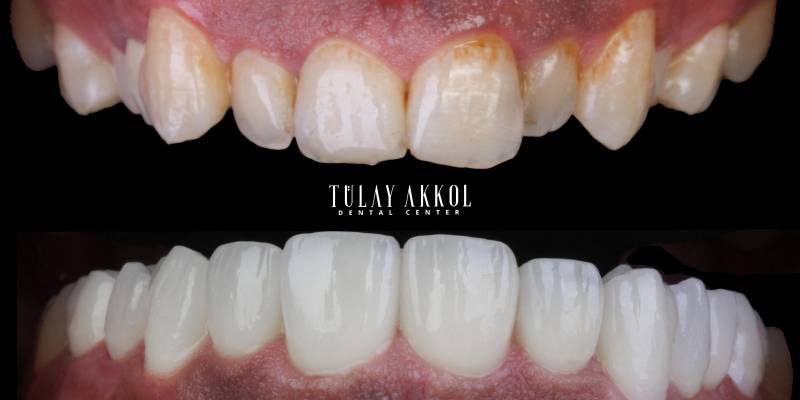 Discovering the Best Veneers in Turkey: Transforming Smiles with Precision and Artistry