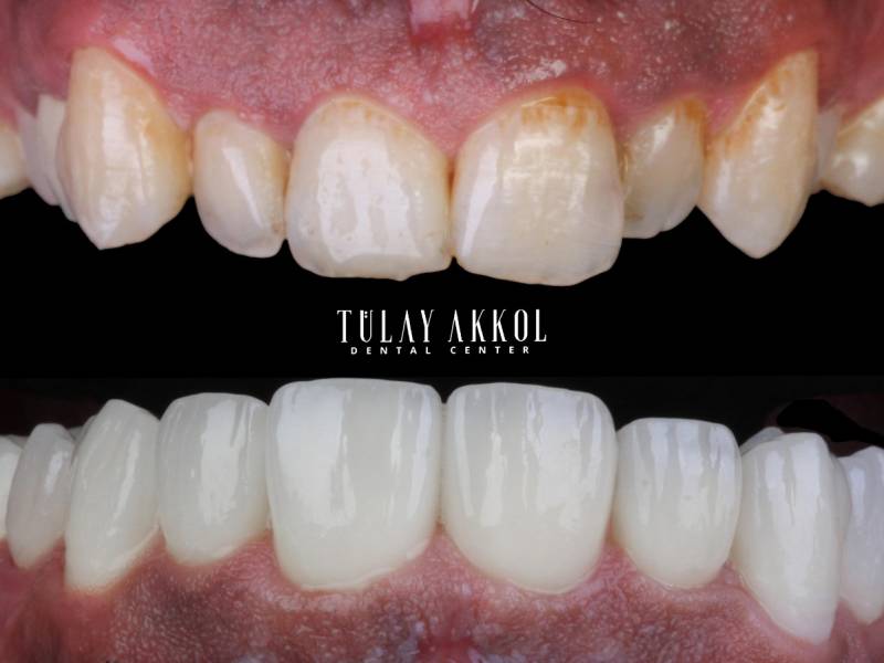 Discovering the Best Veneers in Turkey: Transforming Smiles with Precision and Artistry