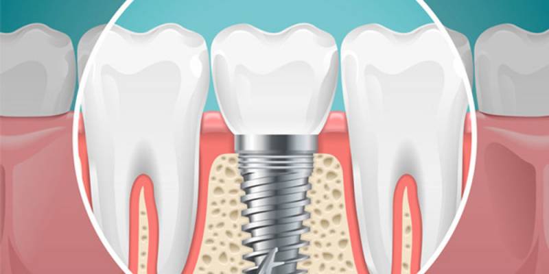 Advantages Of Dental Implants