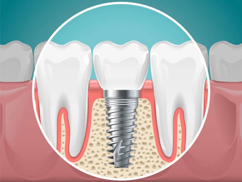 Advantages Of Dental Implants