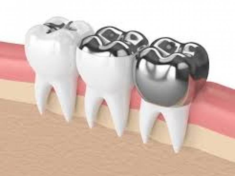 Advantages Of Porcelain Dental Filling