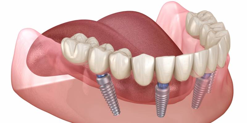 The cost of full dental implants