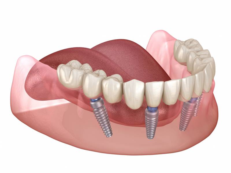 The cost of full dental implants