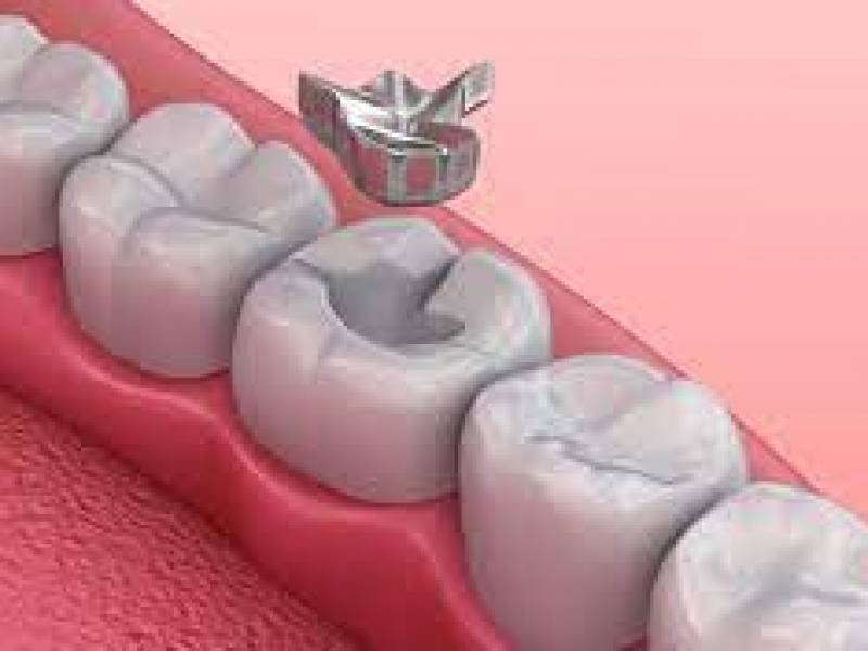 Amalgam Dental Filling