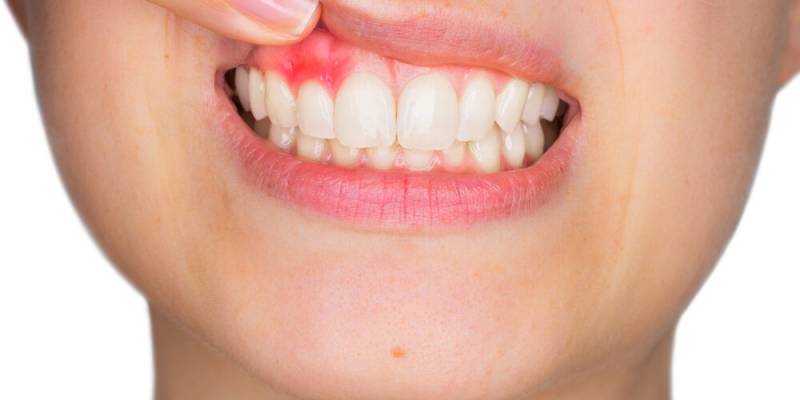 An Abscessed Tooth: Causes, Symptoms, and Treatment