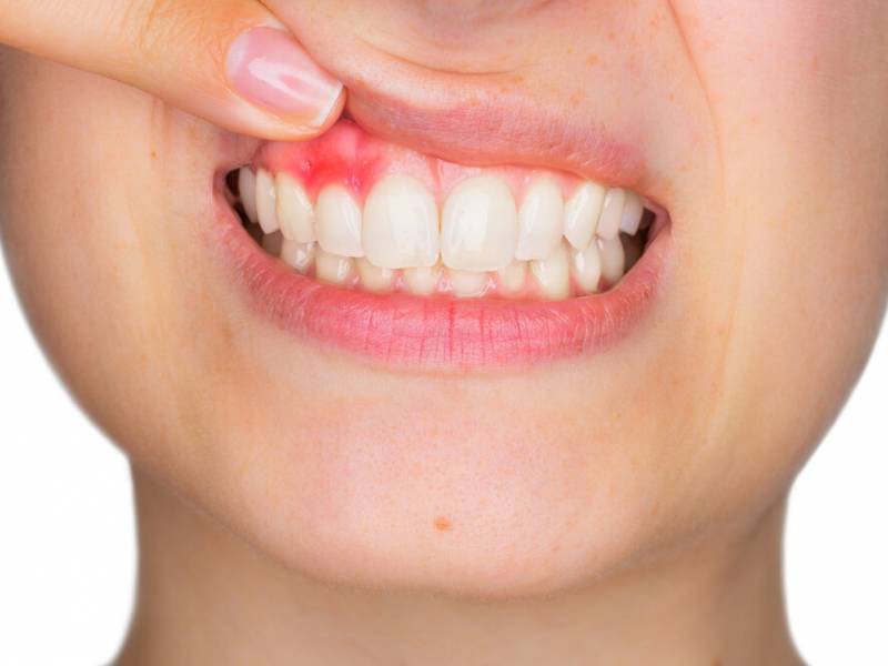 An Abscessed Tooth: Causes, Symptoms, and Treatment