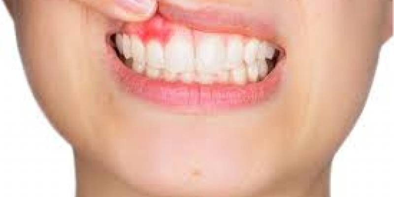 Causes Of Gingivitis