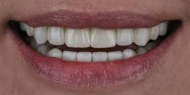 Composıte Veneers