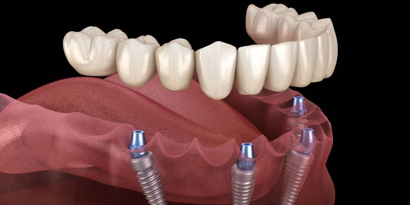 Dental Implants Cost per Tooth in Turkey: A Comprehensive Guide