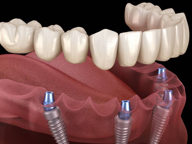 Dental Implants Cost per Tooth in Turkey: A Comprehensive Guide