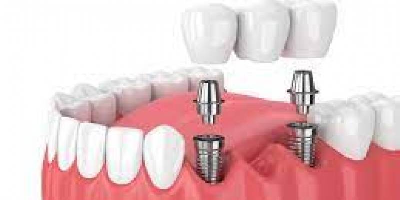 Dental Prosthesis Over Tooth