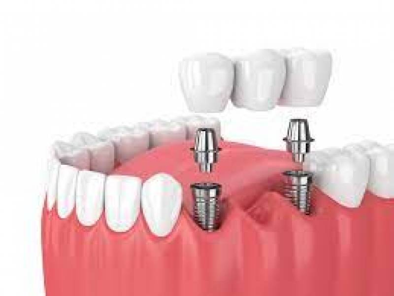 Dental Prosthesis Over Tooth