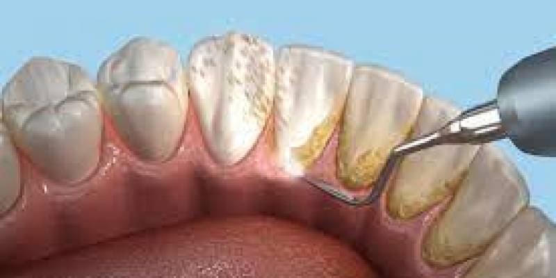 Dental Scaling and Polishing: Everything You Need to Know