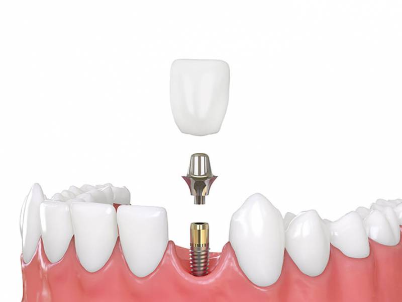 Types Of Dental Implants