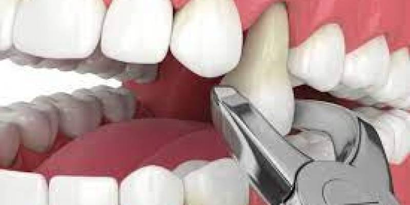 What To Do After Tooth Extraction