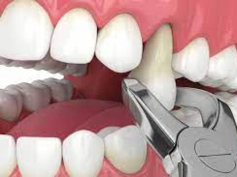 What To Do After Tooth Extraction