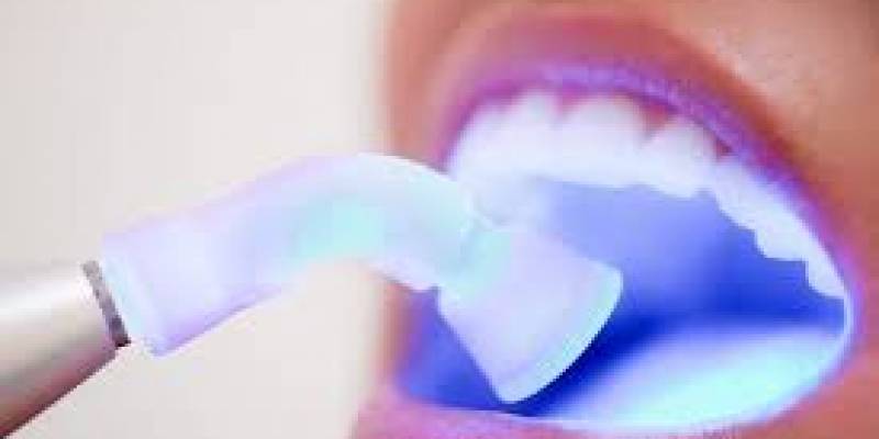 Laser Dental Filling Treatment