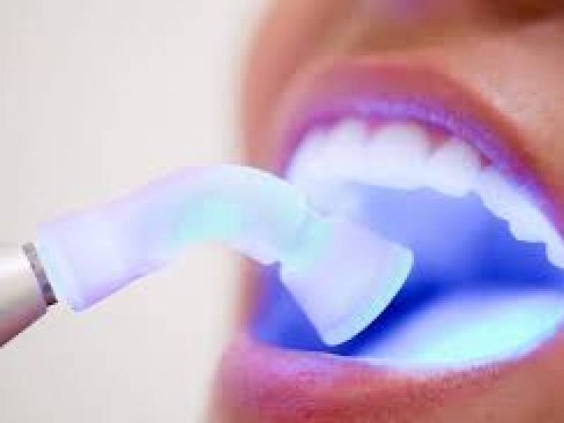 Laser Dental Filling Treatment