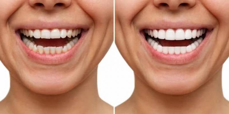 Enhancing Your Smile with Composite Veneers: A Cost-Effective Solution