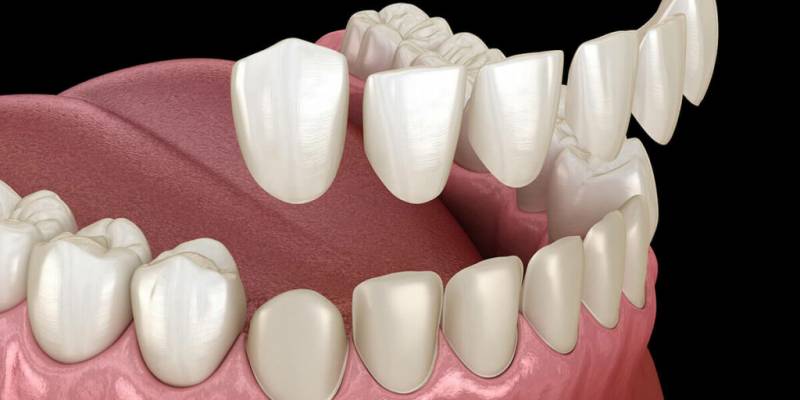 How Is Full Ceramic Dental Veneer Applied?