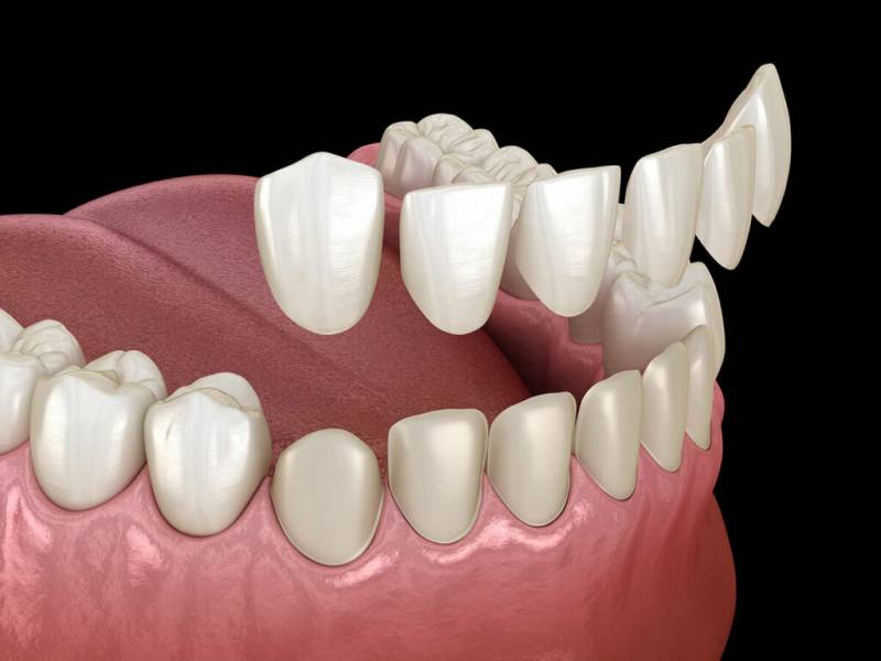 How Is Full Ceramic Dental Veneer Applied?