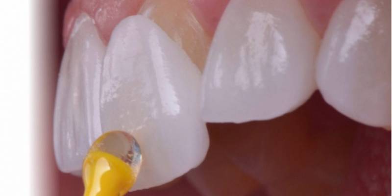 How Is Lamina Porcelain Dental Veneer Applied?