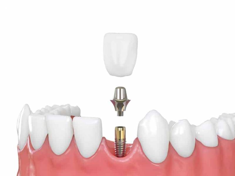 How Is Simple Dental Implant Applied?