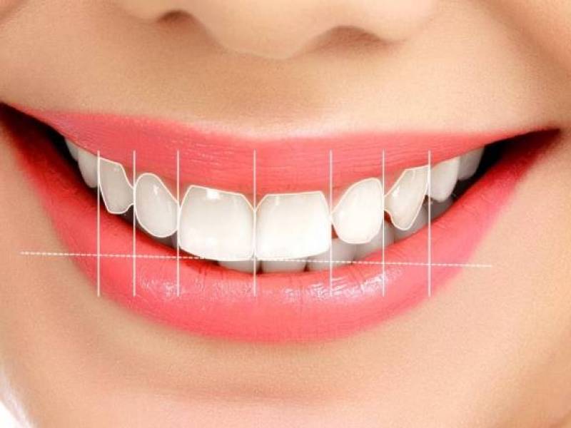 How Is Smile Design Applied?