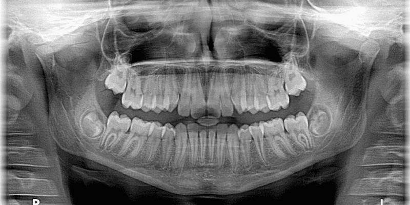 How to Take Occlusal Film