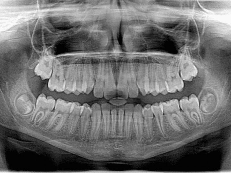 How to Take Occlusal Film