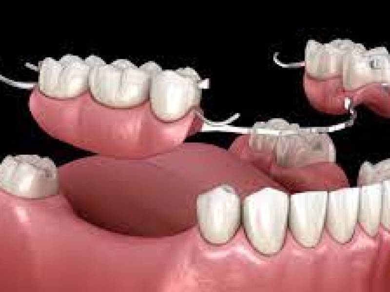 How To Use Removable Dental Prosthesis?