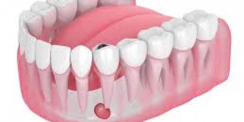 What Are The Risks Of Abscessed Dental Treatment?