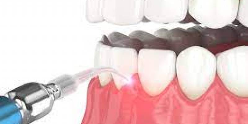 Laser Dental Treatment