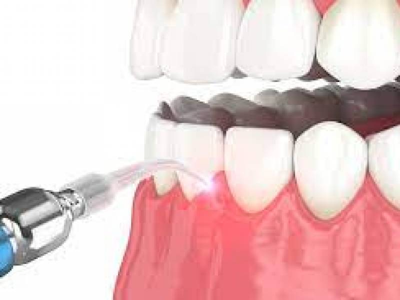 Laser Dental Treatment