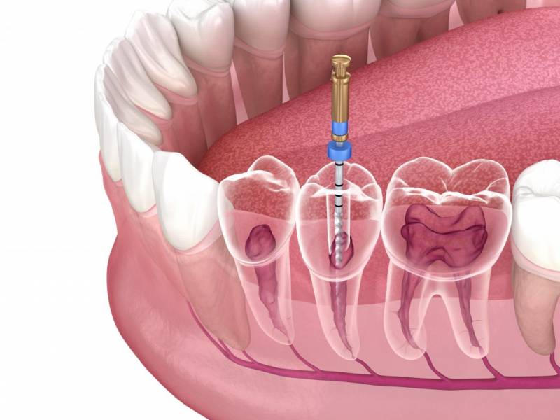 Intra-Canal Post Application