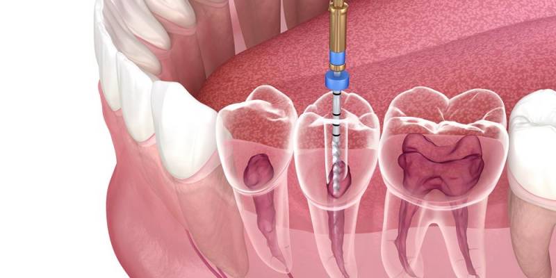 Laser-Assisted Root Canal Treatment